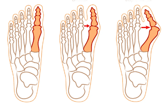 Hallux Valgus deformacija