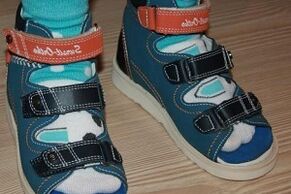 nošenje sandalov za hallux valgus pri otroku