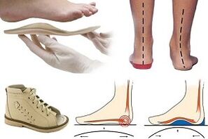 ortopedski čevlji za hallux valgus pri otroku