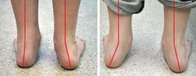 Valgus stopalo