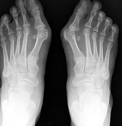 X -ray stopala